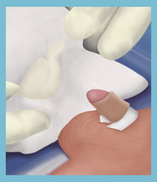 After Circumcision Care - Baby Circumcision Healing - Gentle Procedures NB