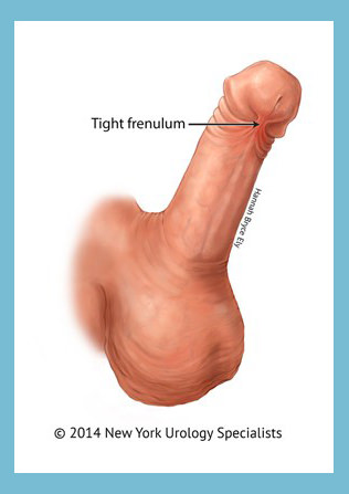 Penis frenectomy for pulling curve