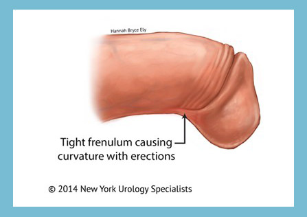 Penile frenulectomy halifax