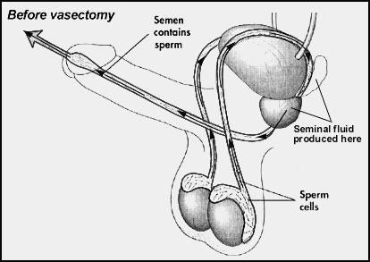 before vasectomy gif explainer