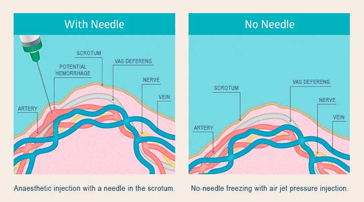 illustration-vasectomy-comparison no needle vasectomy gif