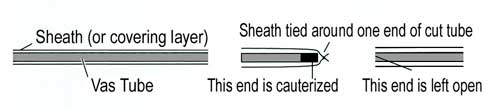open ended vasectomy explained