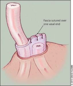fascial interposition vasectomy info